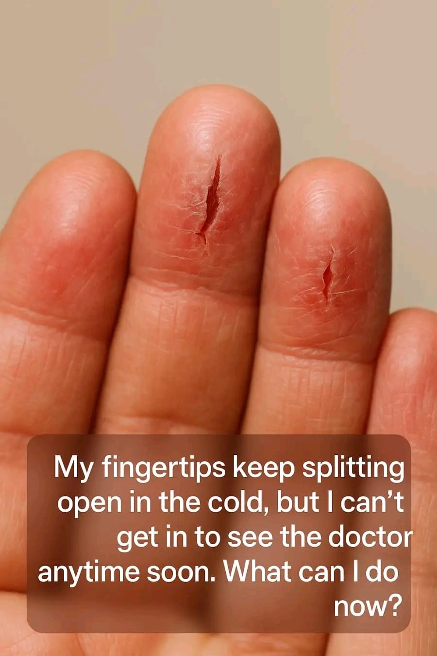 My fingertips keep splitting open in the cold, but I can’t get in to see the doctor anytime soon. What can I do now?