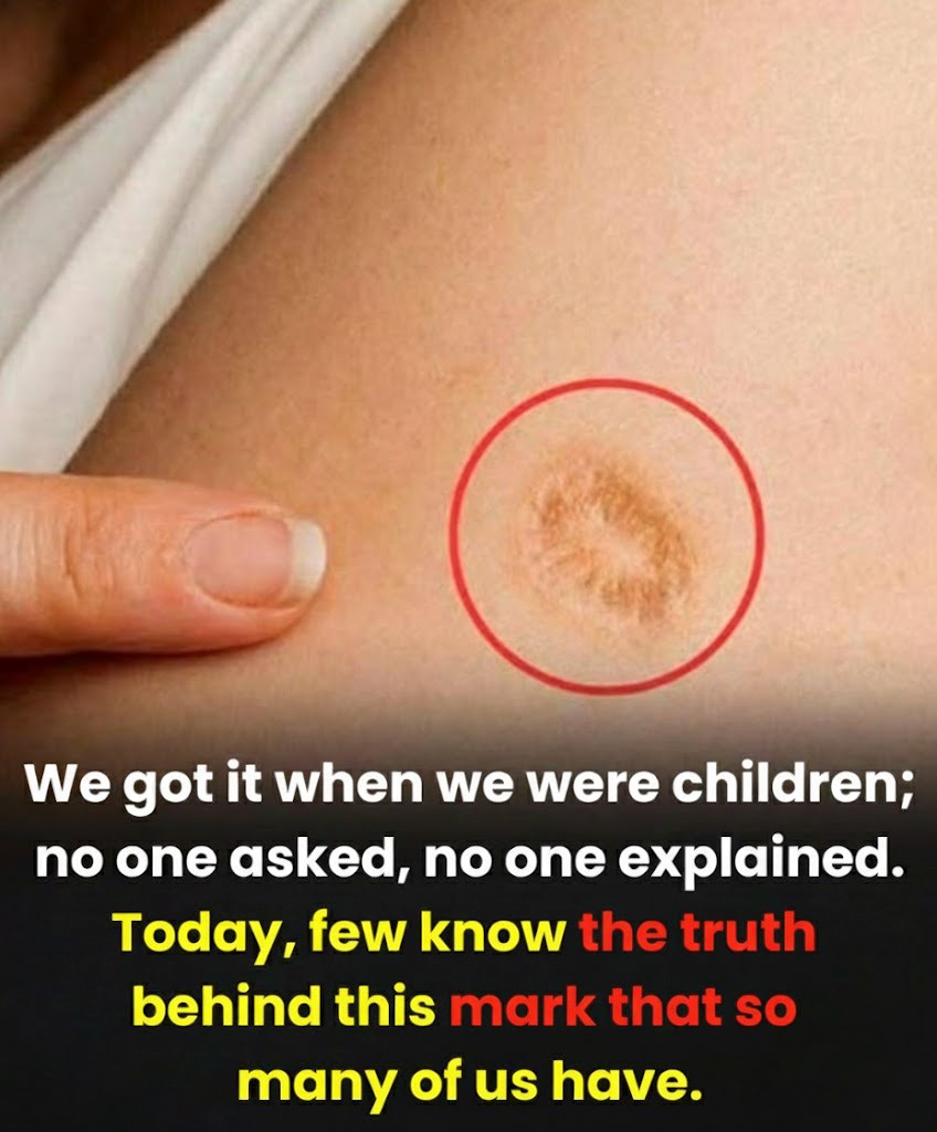 5 Widespread Myths About the Small Round Scar on the Upper Arm