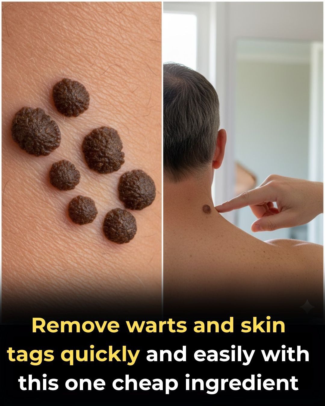 How to Remove Skin Tags and Warts Naturally and Cheaply at Home