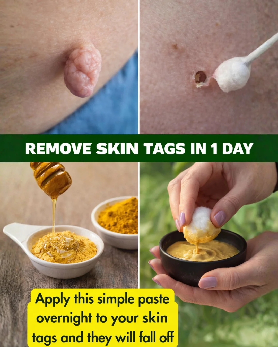 Best Natural Home Remedies To Safely Remove Skin Tags