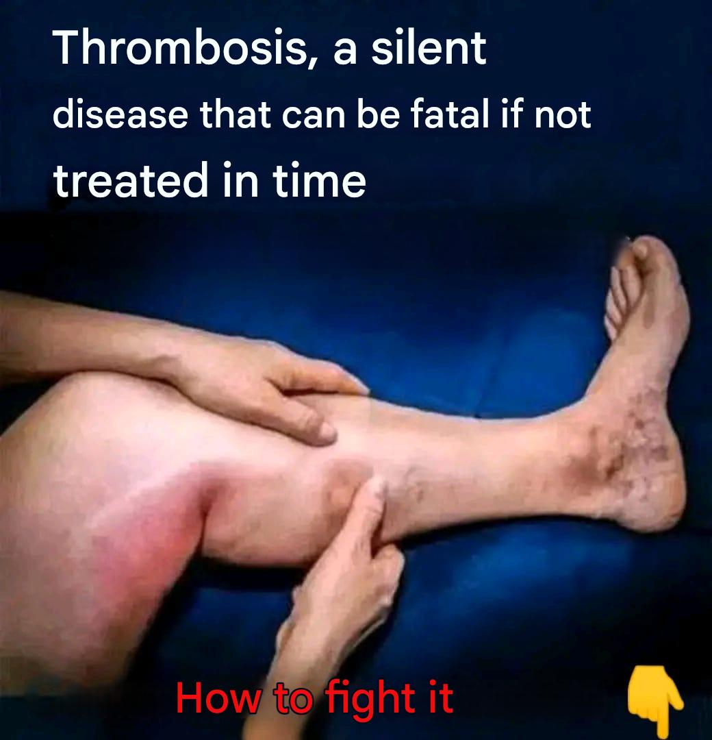 Thrombosis: understanding this silent threat that progresses without warning