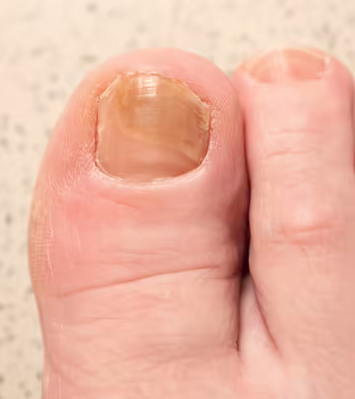 Hydrogen Peroxide For Toenail Fungus: 4 Easy Home Remedies
