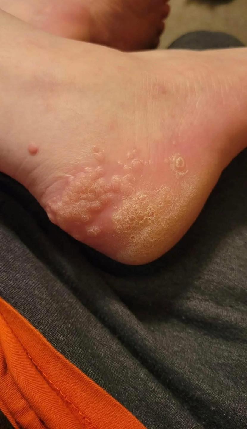 Estas son las consecuencias de usar zapatos usados…